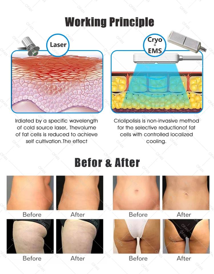 Ofan Beauty Salon Equipment Slimming Fat Freezing Best Price Criolipolisis Machine Cryolipolysis L 532nm Green Laser